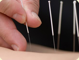 Acupuncture